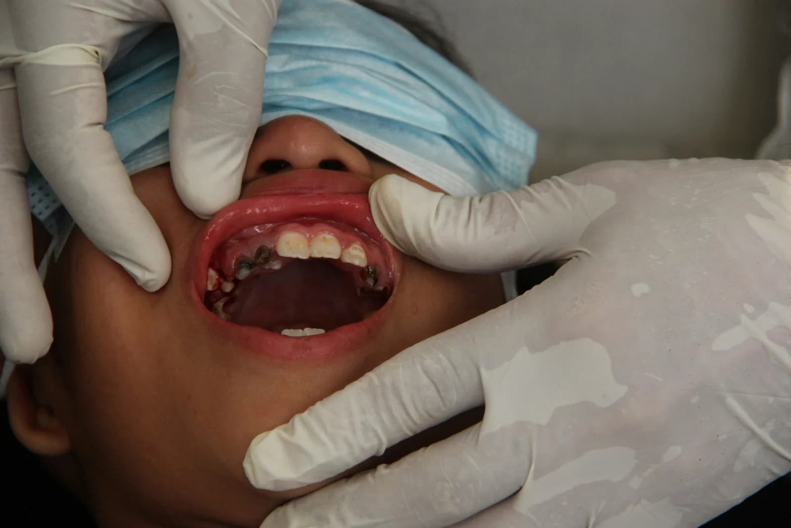 Endodoncia