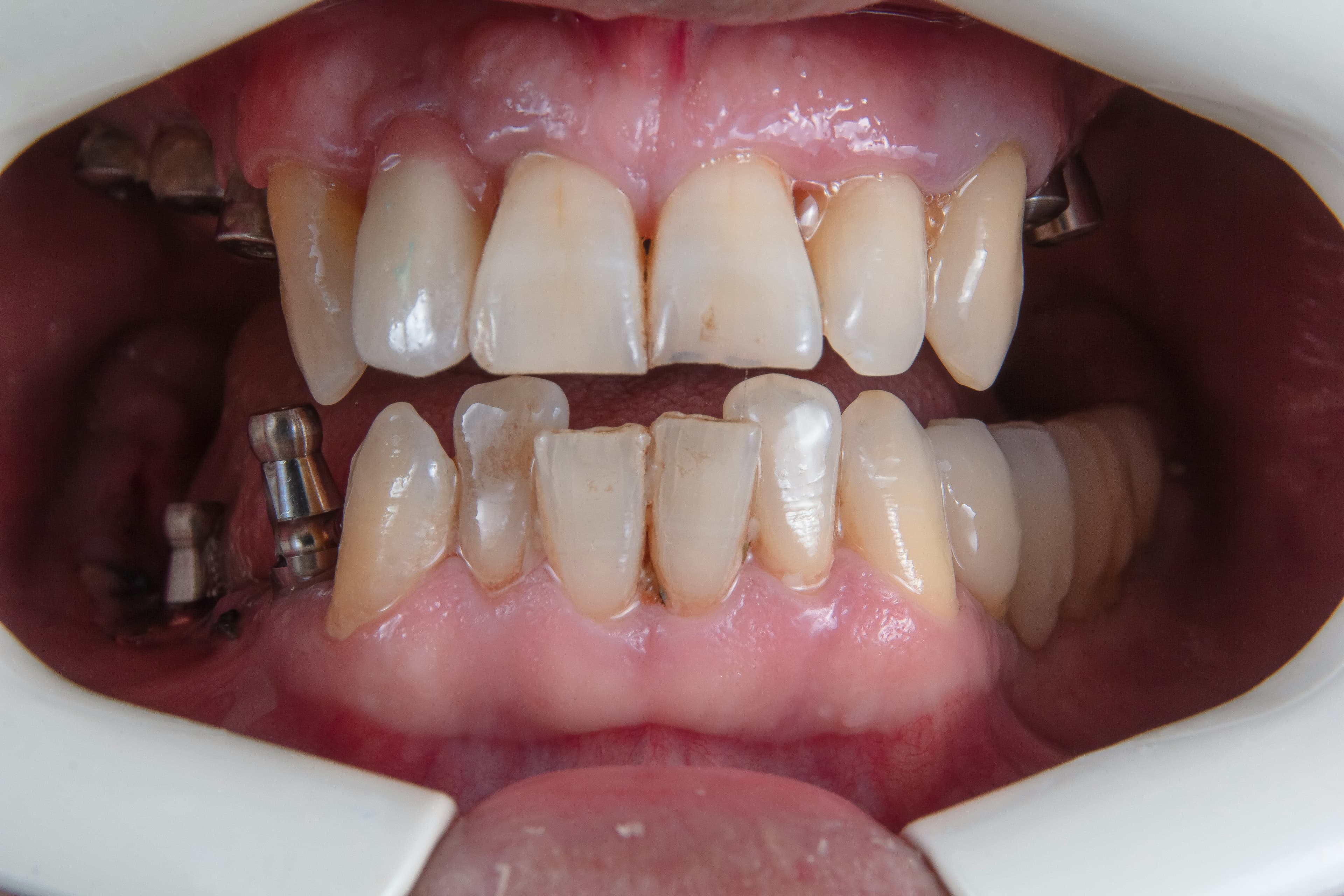 Rehabilitación Oral