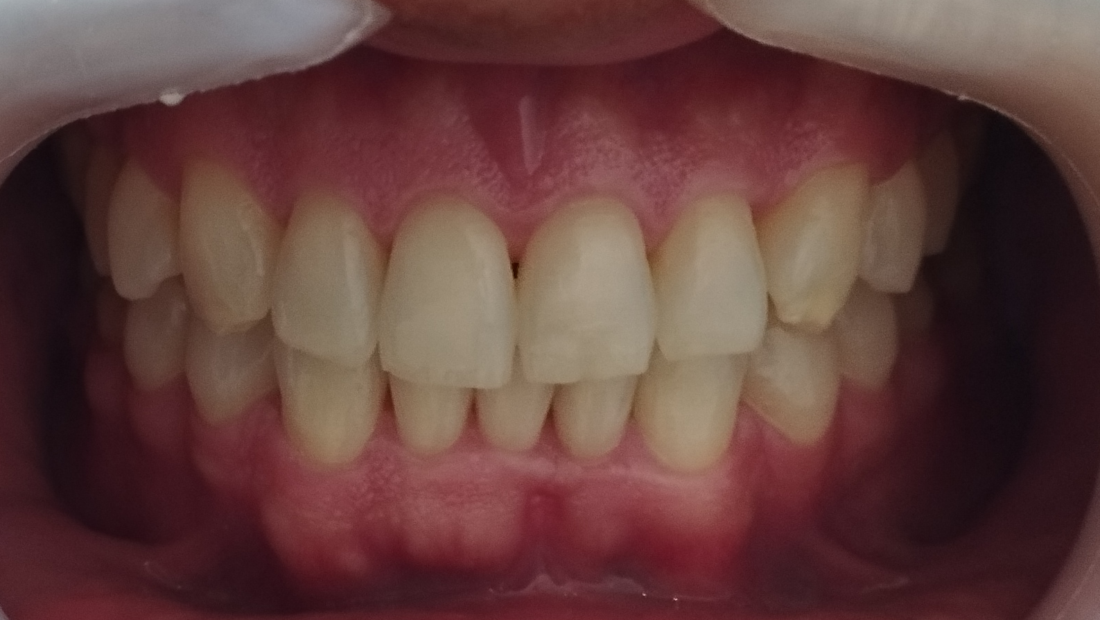 Composite — Antes